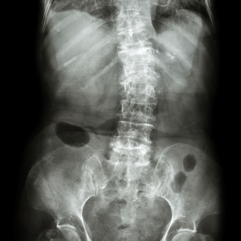 Scoliosis Xray