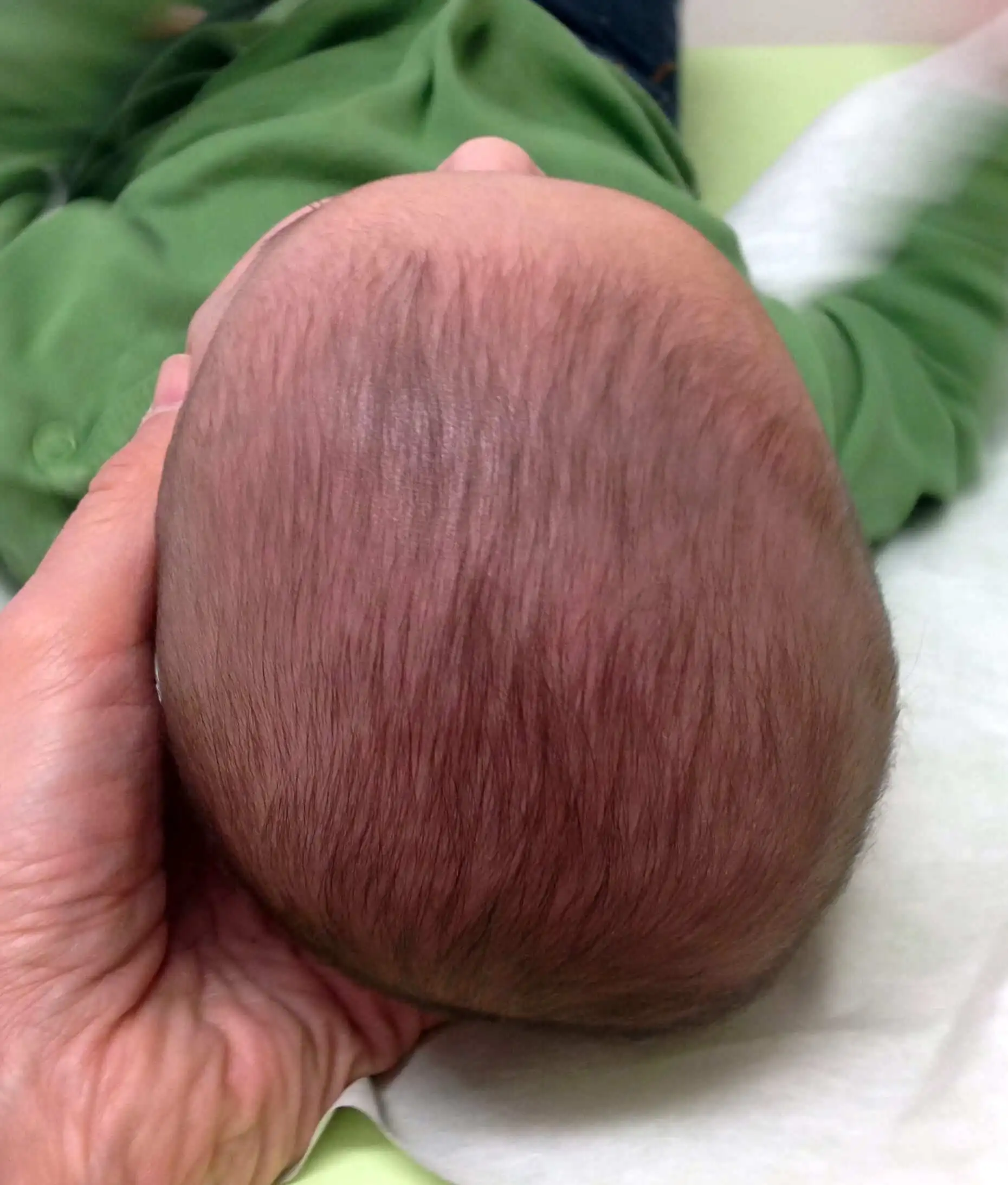 Plagiocephaly