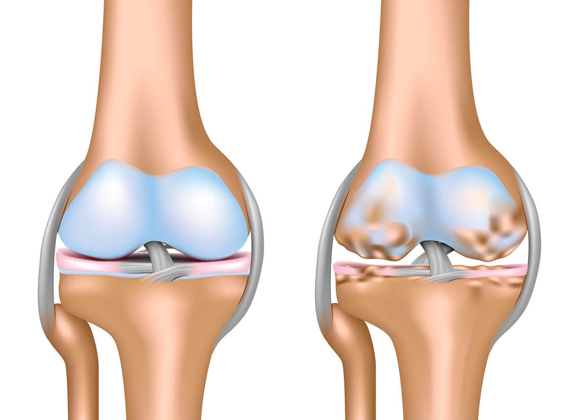 Osteoarthritis