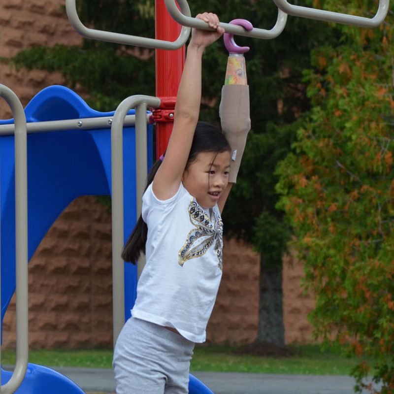 Pediatric Prosthetics